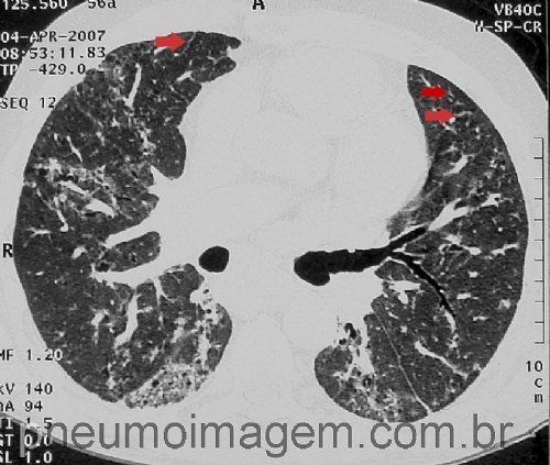 NINTEDANIBE FOI APROVADO PARA NOVA INDICA��O TERAP�UTICA NO BRASIL